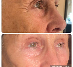 Severely sun damaged skin - 3 sessions into her skin bootcamp
