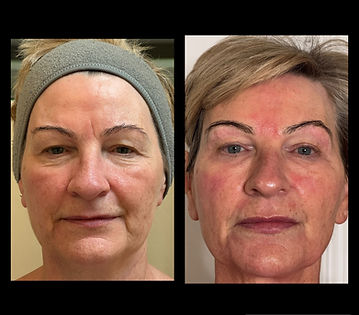 A.G.E skin resurfacing bootcamp (6 x in clinic sessions + homecare kit)