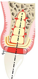 alveolar ridge preservation with PRF