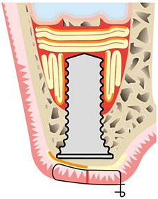 crestal sinus floor elevation with PRF