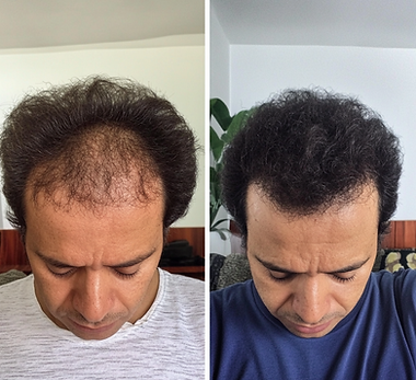 lucas antes e depois