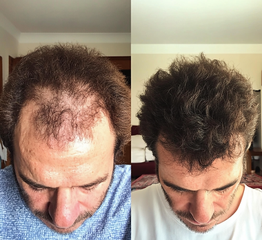 vinicius antes e depois