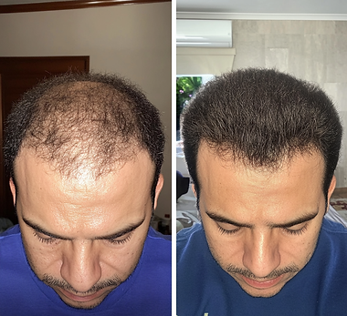 anderson antes e depois