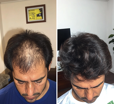 augusto antes e depois