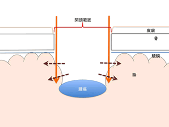 図1 従来の開頭