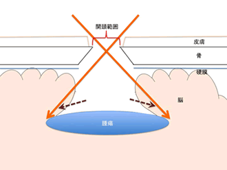 図3 福島式鍵穴手術