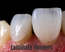 Laminate-Veneers_edited.jpg