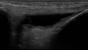 Deep infrapatellar bursitis