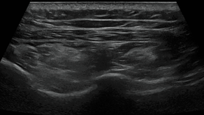 Infraspinatus fatty degeneration