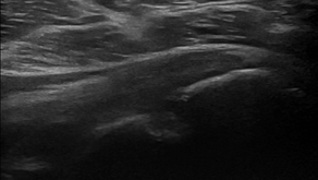 Hill-Sachs lesion