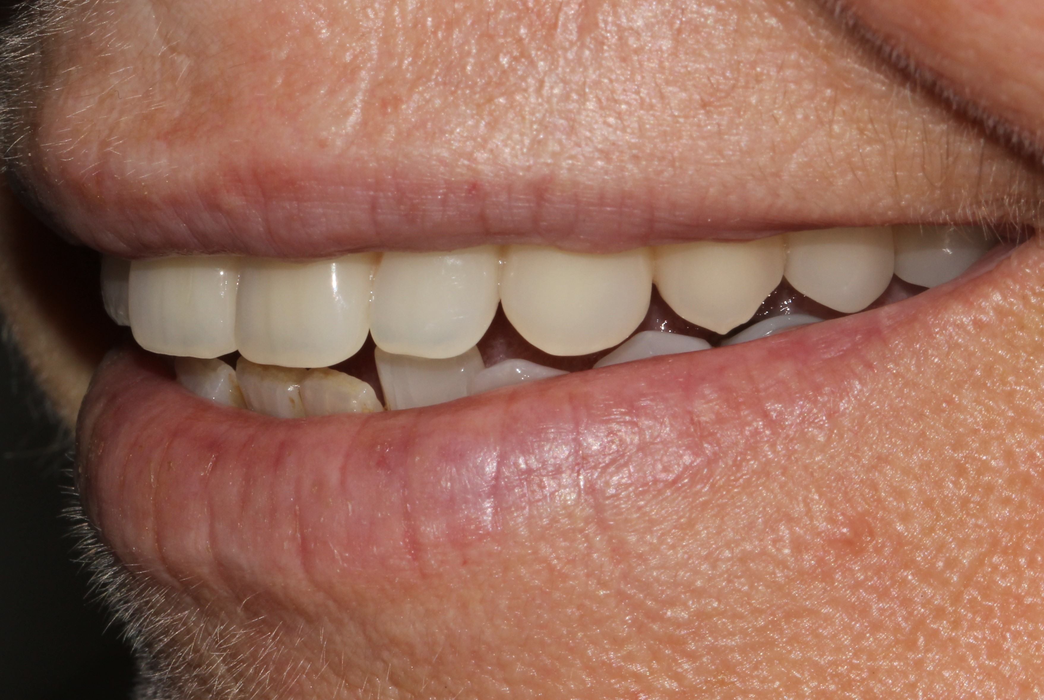 New Denture