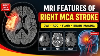MRI Features of Right MCA Stroke