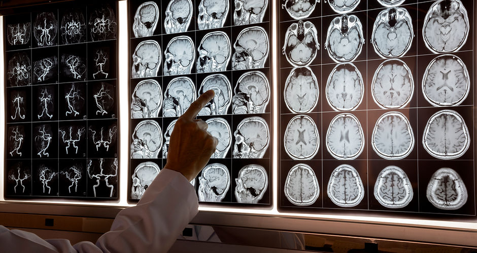 Neurologist looking at a brain MRI scan