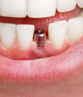 Dental Implants