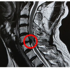 交通事故のむち打ちで手がしびれる症例
