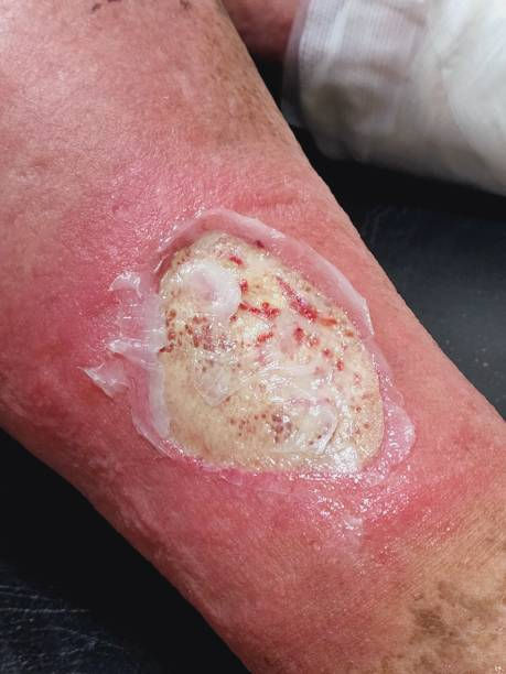 ulcer.jpg