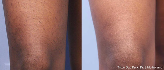 Triton Hair removal on legs
