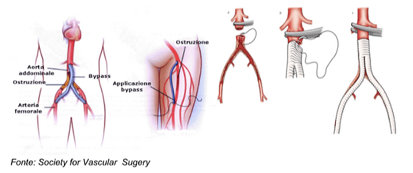 pernas para doença vascular periférica