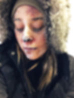 Frost Bite