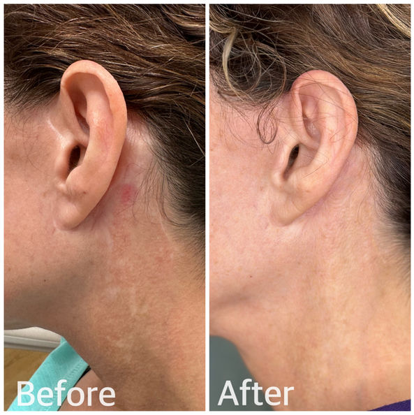 scar cover up for facelift La Jolla