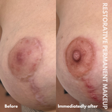 3DAreola restoration: Post Breast Lift