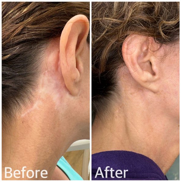 facelift scar camouflage before and after San Diego