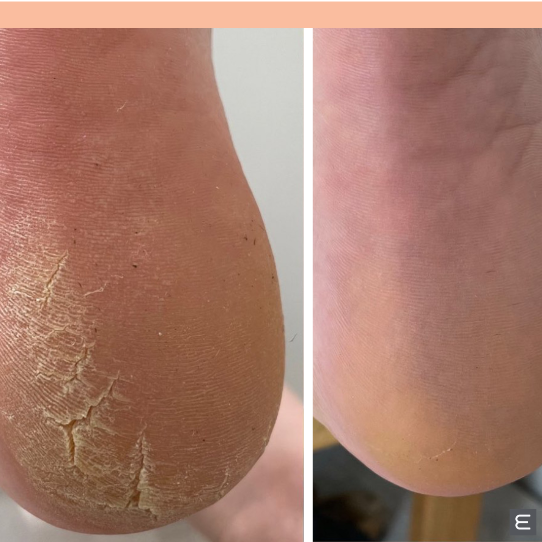 ELIM Medi Heel Pedicure thepolishroom