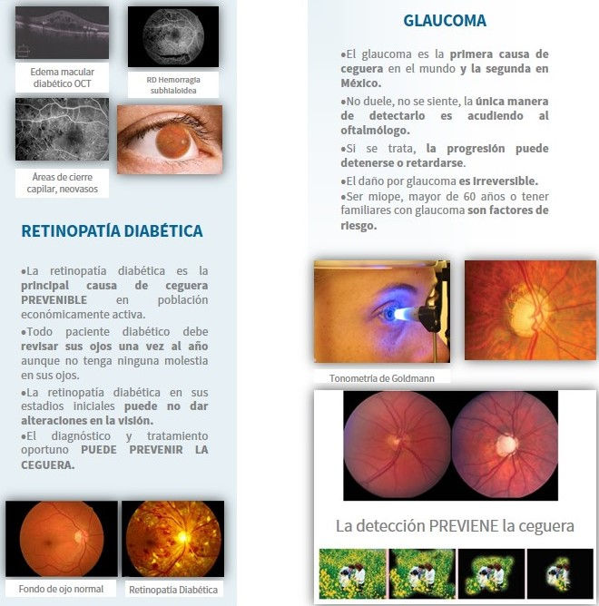 Retinopatía Diabética y Glaucoma