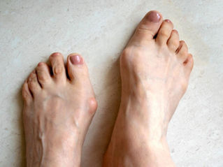 J’ai un Hallux Valgus – que peut faire Diawin pour moi ?