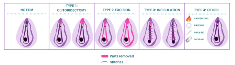 4 Types of FGM: Infographic depicting the four types of FGM: clitoridectomy, excision, infibulation, and other harmful practices.