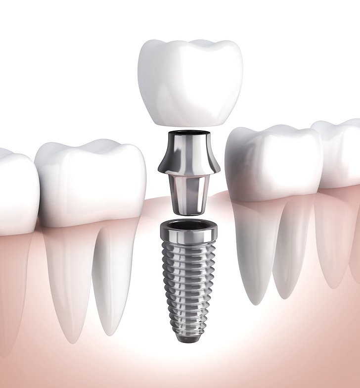 implant-diagram_edited.jpg