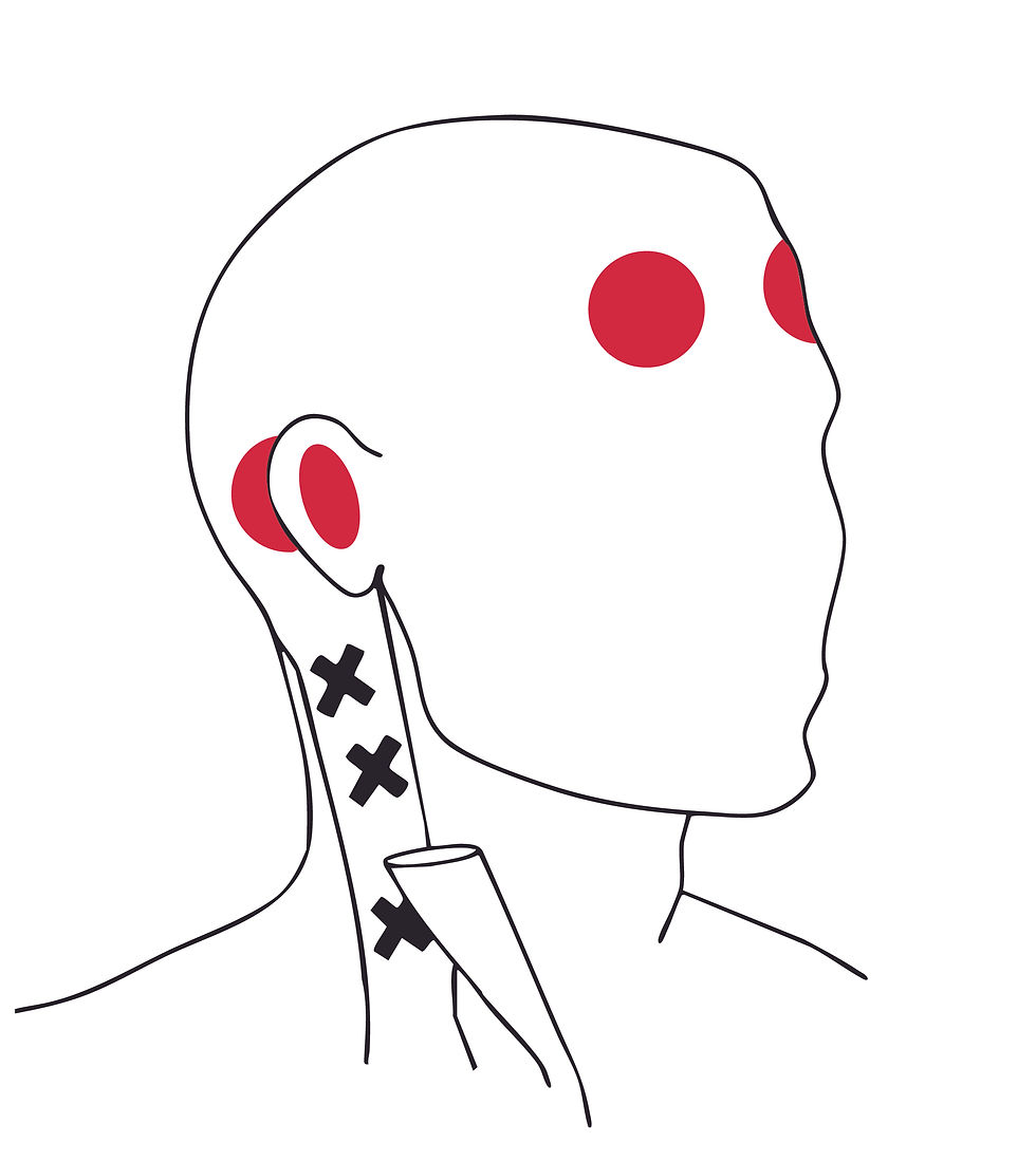 הקרנת כאב משריר Sternocleidomastoid לאזור הראש. אזורי ההקרנה מסומנים בצבע אדום. איור: נופר הברמן