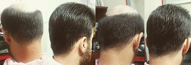 haarersatz und haarprothesen als