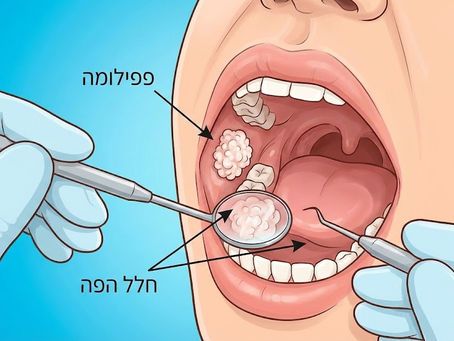 פפילומות בחלל הפה – חשיבות האבחון המוקדם והטיפול הכירורגי