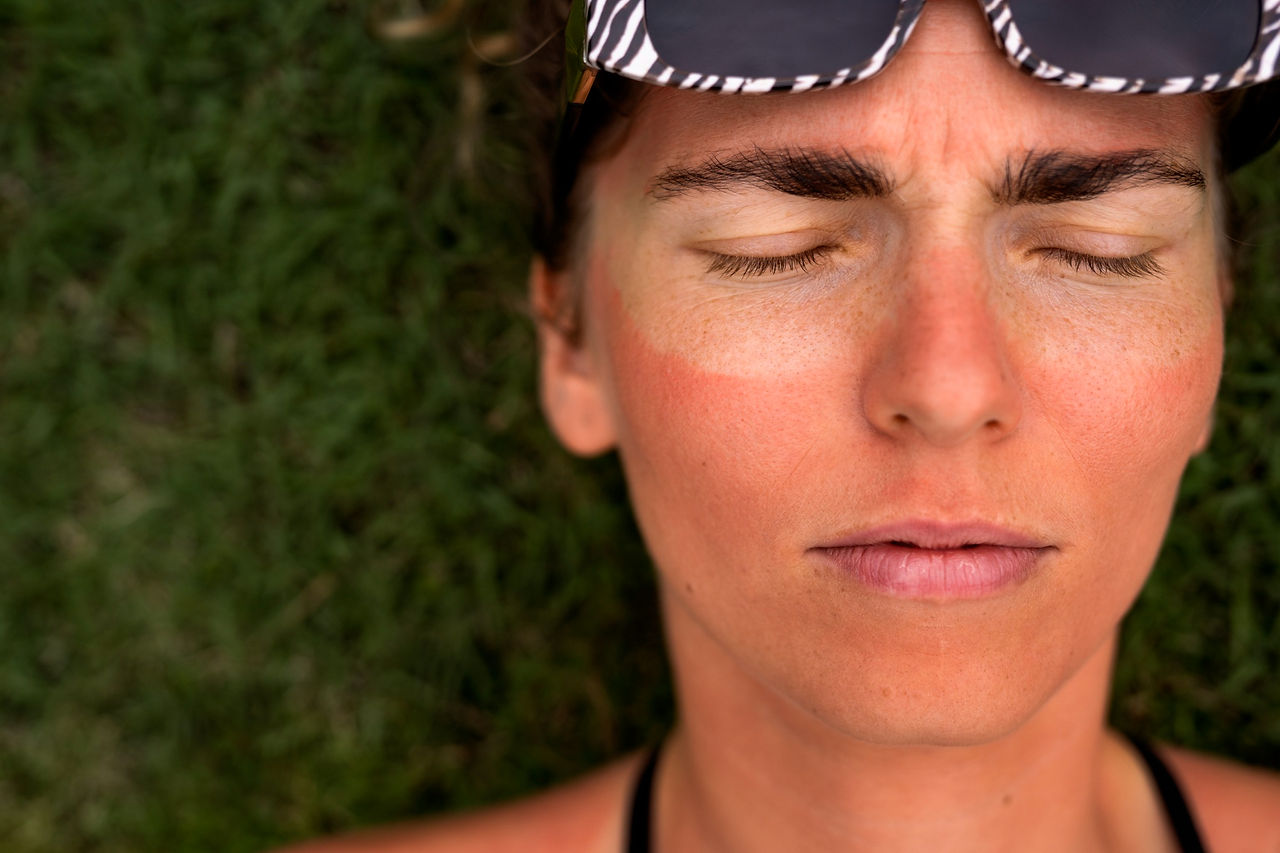 woman with sunburn for skipping spf