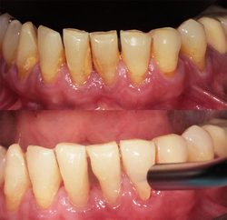 Tartar Bottom Front teeth