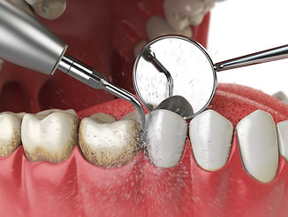 Dental cleaning.jpg