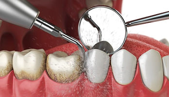 Dental cleaning.jpg