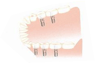 インプラント使用時の様子