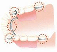 部分入れ歯の様子