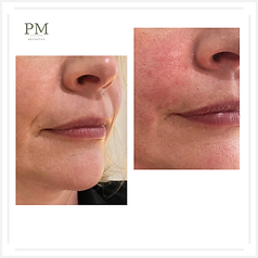 Close-up facial dermal filler comparison at Paramed Aesthetics
