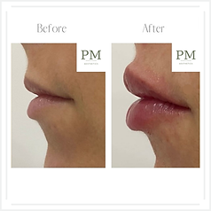 Before and after lip volume enhancement at Paramed Aesthetics