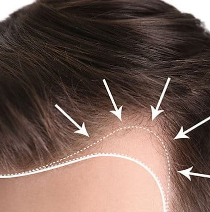 hair-transplant-in-summer-1200x900.jpg