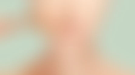 Melasma e a importância do protetor solar no cuidado com a pele