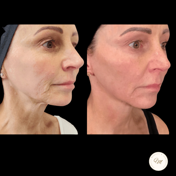 Morpheus8 Before and After