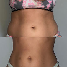 Fat Dissolving, The Lemon Bottle, Slimming, Fat Loss, York.