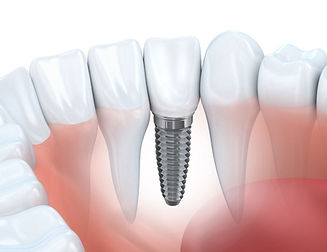 implantologia-guarigione-iStock-519555723_cut-1.jpg