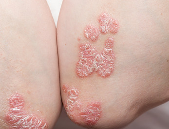 problem skin psoriasis on the body. exacerbation of psoriasis. stress and illness_.jpg