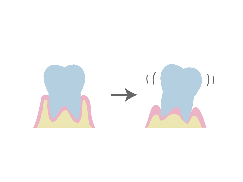 歯周病はどんな病気?〜歯周病の話①〜