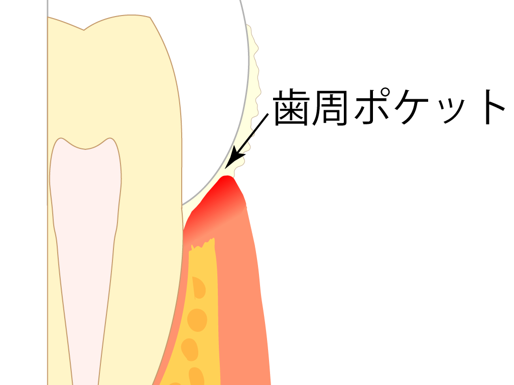 歯周炎 歯周ポケット